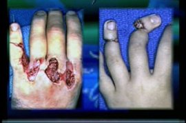 HAND INJURIES - GORY STORY - 14 Min.