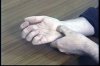 CARPAL TUNNEL SYNDROME - 12 Min.