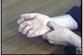 CARPAL TUNNEL SYNDROME - 12 Min.