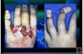 HAND INJURIES - GORY STORY - 14 Min.